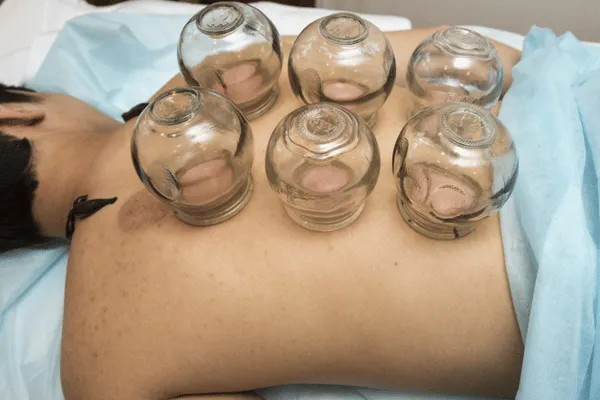 Sports Recovery Benefits of Cupping Therapy Sessions
